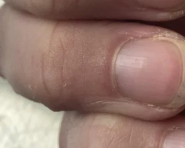 Promena na noktu znak smrtonosnog raka: Otišla na pregled i saznala najgore vesti – život joj postao horor