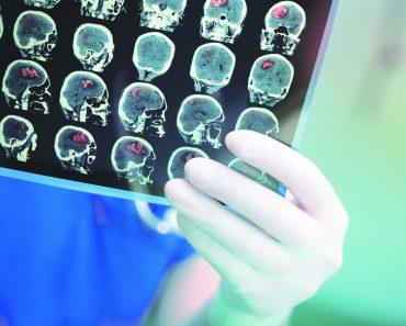 Moždani udar dolazi sa najavom: Ako primetite ove znakove, hitno se javite lekaru