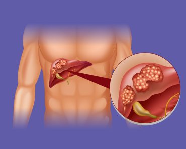 Prvi simptom raka jetre javlja se dok jedete – Mnogi ga zanemaruju, a znakovi su očigledni Prvi simptom raka jetre javlja se dok jedete – Mnogi ga zanemaruju, a znakovi su očigledni